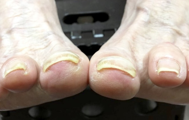 巻爪ケア5か月後の様子