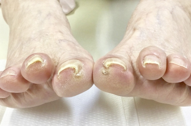 巻爪の患者様