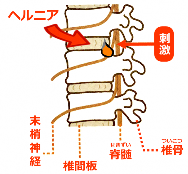 腰椎椎間板ヘルニア